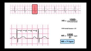 Determine HR from a RegularRhythm EKG  1500 amp 300methods [upl. by Eyllib]