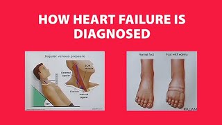 How Heart Failure is Diagnosed [upl. by Aba]