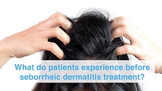 What do patients experience before seborrheic dermatitis treatment [upl. by Ahsram631]