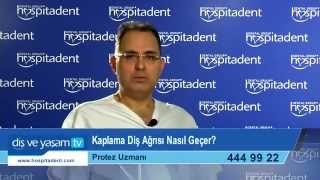 Kaplama Diş Ağrısı Nasıl Geçer [upl. by Kemppe]