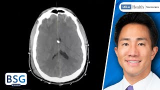 Intracranial Pressure ICP Management [upl. by Ardnasirhc914]