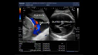 Ultrasound Video showing Cephalopelvic disproportion due to Hydrocephalus [upl. by Ettenahc]