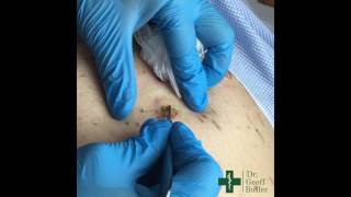 Removal of Seborrheic Keratosis [upl. by Hgielsa]