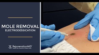 Electrodessication to Remove Seborrheic Keratosis [upl. by Aihc]