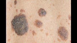 seborrheic keratosis removal beautyteck [upl. by Tessi]