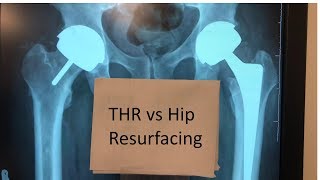 Difference Between Hip Resurfacing And Total Hip Replacement [upl. by Mialliw902]