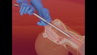 Nasotracheal suctioning NTS  3D animation [upl. by Atteuqihc]